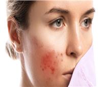 منها زيت جوز الهند.. علاجات منزلية لالتهاب الجريبات