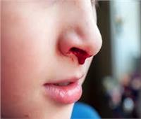 الكيّ لعلاج نزيف الأنف المتكرر.. متى يُستخدم وما أهم فوائده ومخاطره؟