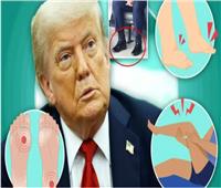 الفحص الطبي لترامب يكشف وجود مشاكل صحية.. 10 أعراض للقصور الوريدي
