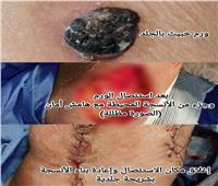 لأول مرة.. فريق طبي يجري جراحتين ورم سرطاني وتشوه بالأذن بدمياط 