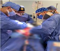 نجاح جراحة معقدة لتصحيح اعوجاج وتحدب العمود الفقري لطفلة بمستشفيات جامعة قناة السويس