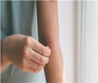 علاجات جديدة لالتهاب الجلد التأتبي