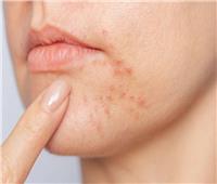 تعانين من حب الشباب.. طبيبة تجميل تكشف عن مكون غير معروف يمنحك بشرة أوضح