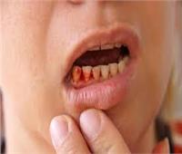 حكم ابتلاع الصائم دم اللثة أثناء النوم.. هل يفسد صيامه؟ 