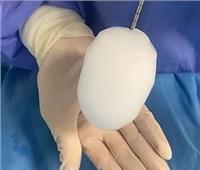 "التجميد" | علاج حديث للسرطان يساعد المرضى على عيش حياة أفضل
