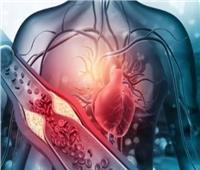  أعراض انسداد الشرايين وطرق الوقاية منه.. احذر العلامات المبكرة