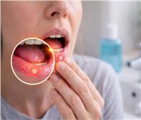 قد تسبب ألمًا مزعجًا خاصة أثناء تناول الطعام.. متى تستدعي قرح الفم زيارة الطبيب؟