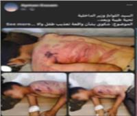 ضبط شخصين لاتهامهما بتعذيب طفل وإصابته في المنوفية