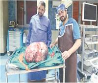 استئصال ورم عملاق يزن 24 كيلوجرامًا داخل مستشفى بالمنيا